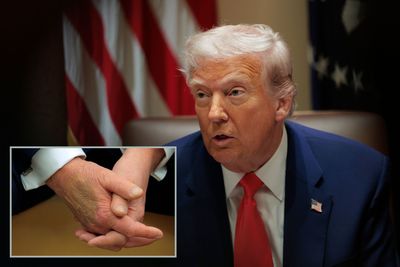Trump's Nearly 5-Hour Physical Exam Raises Questions About His Health After Massive Bruise Saga